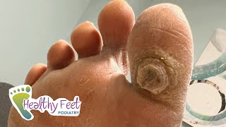 DEEP SATISFYING CALLUS TREATMENT [upl. by Norty457]