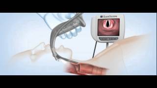 GlideScope Titanium Video Laryngoscopes Demonstration [upl. by Ahserak]