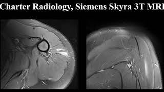 Shoulder MRI Osteochondromatosis [upl. by Emmalynne]