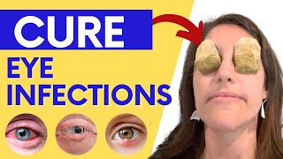 How to Treat Eye Infections Eye Allergies and Pink Eye Naturally at Home [upl. by Girard]