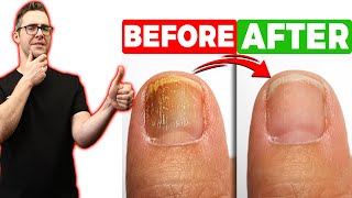 BEST Toenail Fungus Treatment 2024 4 BIG SECRETS [upl. by Halda]