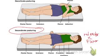 Decerebrate Vs Decorticate Posturing [upl. by Oicnedif]