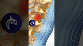 Cervical Selective Nerve Root Block SNRB anatomy orthopedics spine [upl. by Sedda618]