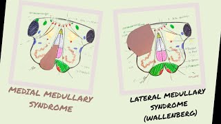 Medial amp Lateral Medullary Syndromes  Wallenberg Syndrome  Vascular lesions of Medulla [upl. by Lorianne]