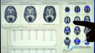 MindGenesis Alzheimers Disease Early Detection Diagnostic in Littleton Colorado [upl. by Howlend]