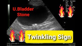 Urinary Bladder stone l Twinkling Sign l💥💥💥 [upl. by Adeys]