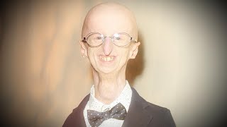 Sammy Basso Oldest Living Person With Progeria Dies at 28 [upl. by Disini568]