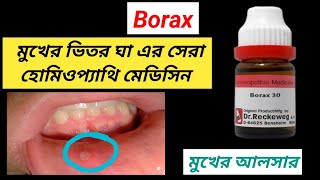 Borax Homeopathic Dava । Mouth Ulcer Treatment । [upl. by Fiann]