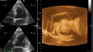 4D ECHO TENDON ANTERO SEPTAL AKINESIA [upl. by Fugate]