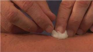 Acupuncture Treatments  Acupuncture for Elbow Tendinitis [upl. by Atinus285]