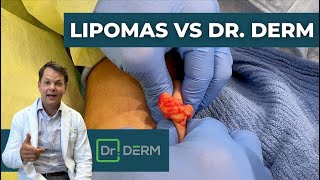 Lipomas vs Dr Derm  Dr Derm [upl. by Bernarr854]