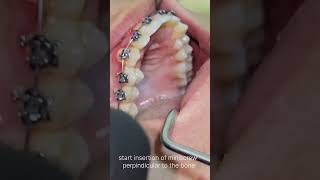 steps of interradicular orthodontic miniscrew DrEslam samir go ahead ortho [upl. by Muiram128]