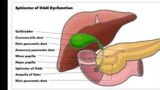 Mystery diagnosis sphincter of oddi dysfunction [upl. by Zoba]