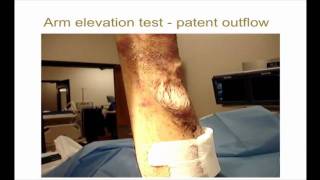 10minute Rounds Arm Elevation and the Arteriovenous Fistula [upl. by Geanine]