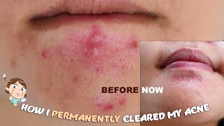 How I cleared by Hormonal Acne amp Scars [upl. by Roper]