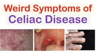 Weird Symptoms of Celiac Disease  Atypical Clinical Features [upl. by Maggy]