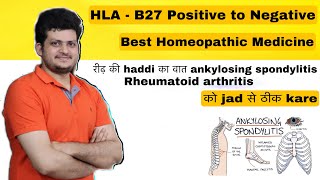 HLAB27 positive to Negative  Homeopathic medicine  Ankylosing spondylitis  Rheumatoid arthritis [upl. by Iver920]