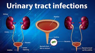 Understanding Urosepsis A 3D Animated Guide [upl. by Mccutcheon42]