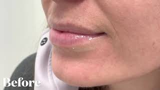 Watch This Lip Filler Transformation With Just One Syringe Of Juvéderm Volbella [upl. by Nace]