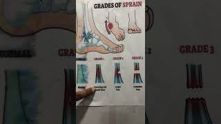 Ankle Injuries Explained Grades 13rd youtubeshorts viralvideo [upl. by Oalsecnew]