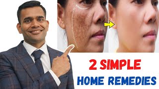 15 Days Challenge Remove Dark Spots Acne Scars Pimples marks And Pigmentation [upl. by Nnael]