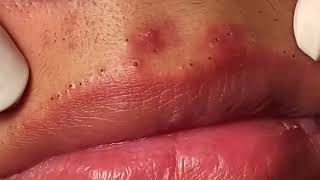 Most Painful Blackhead Removal on Lips [upl. by Asilad]