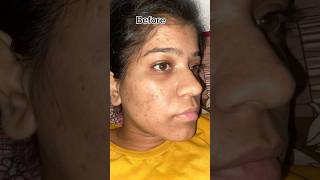 Tretinoin complet 14 month tretinoin0025 tretinoin acne darkspots pimple blackheads shorts [upl. by Ennayt]