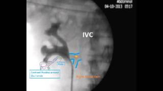 RIRS and IntraRenal Reflux [upl. by Josh]