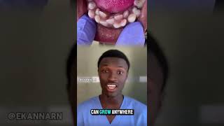 Hyperdontia is a condition where a person has extra teeth known as supernumerary teeth hyperdontia [upl. by Bessy]