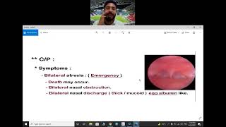 1congenital diseases of nose  choanal atresia [upl. by Namia]