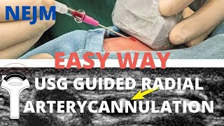 USG Guided Radial Artery Cannulation  A different approach  NEJM Tutorial [upl. by Chafee]