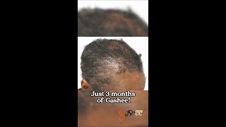 What 3 Months of Gashee Can Do for Traction Alopecia [upl. by Gem]