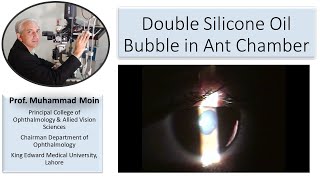 Double Silicone oil bubble in AC after complicated vitrectomy [upl. by Anaeel437]