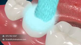 Dental Sealants  Tooth Decay Treatment [upl. by Hollander601]