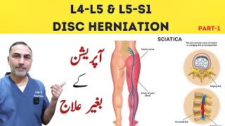 L4  L5 and L5 S1 Disc Herniation Treatment  Slip Disc Treatment At Home sciatica [upl. by Eecrad]