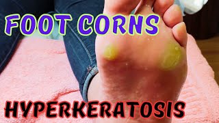 Satisfying foot corns removal Hyperkeratosis [upl. by Jarret]