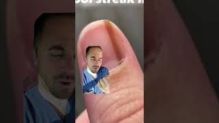 Subungual melanoma in the nail  Doctor reacts striate melanonychia subungualmelanoma [upl. by Drucie]