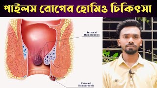 পাইলস থেকে মুক্তির হোমিও চিকিৎসা। পাইলস এর বেস্ট কিছু হোমিও মেডিসিন। Mahir Homeo Hall [upl. by Ennoid]