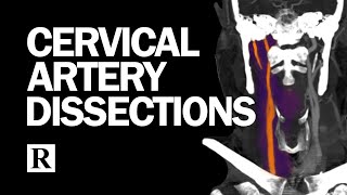 Cervical Arterial Dissections [upl. by Gustie]