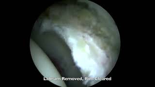 Hip Labral Reconstruction [upl. by Enaillil]