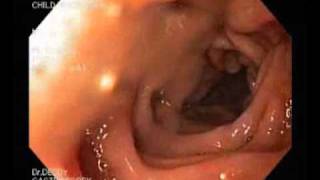 Gastroscopy  gastritis hyperemia and esophagitiswmv [upl. by Akimed]