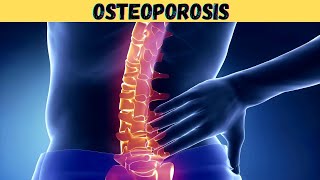 What is Osteoporosis 3d animation  pathophysiology symptoms causes  estrogen  old age  kya hindi [upl. by Anerroc95]