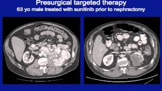 What is the role for cytoreductive surgery in the treatment of metastatic renal cell carcinoma [upl. by Nylrebma]