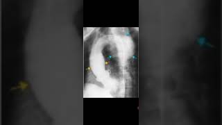 Syphilitic Aneurysm Aortography RadiologyAscending and Descending Aorta calcified Awerenes of all [upl. by Eecyal]