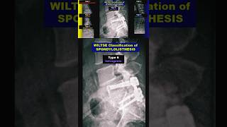 Spondylolisthesis  Wiltse Classification radiology bones spine xray [upl. by Assilrac]