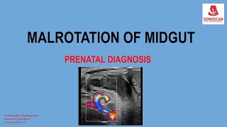 FETAL MALROTATION OF MIDGUT [upl. by Thrasher]