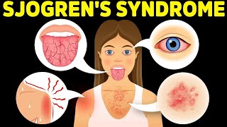 The Best Protocol for Sjogrens Syndrome [upl. by Ahtera740]