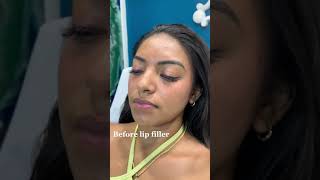 Stunning Lip Filler Transformation  Before amp After with Dr Dahabra in Florida shorts [upl. by Noiwtna]