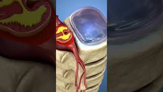 Lumbar disc prolapse  Slip Disk  Dr Dheeraj Batheja sciatica diskherniation slipdisk scoliosis [upl. by Enahsal975]