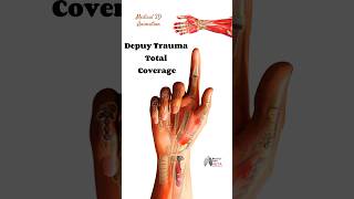 Depuy Trauma Total Coverage medical animation 3d short BiologywithAliya [upl. by Vannie]